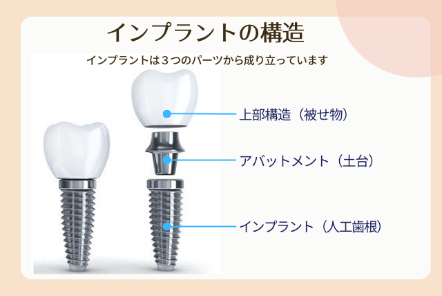 インプラントの構造