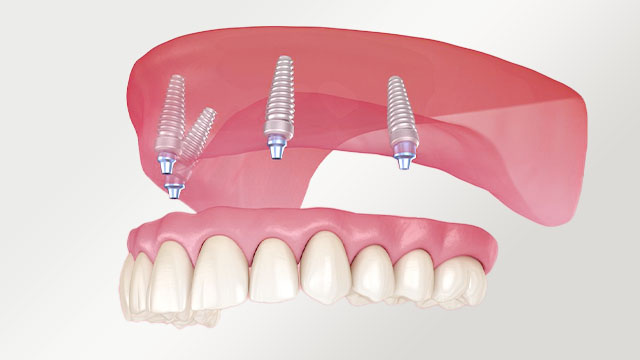 オールオン4が向いている方
